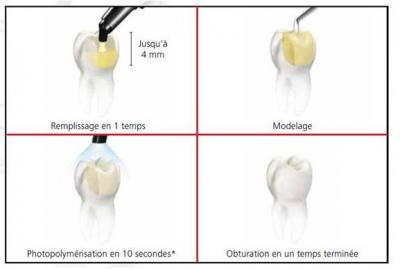 Remplacement de plombages dentaires par des composites Bagnolet (93170)