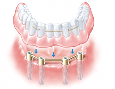 Dentier sur implant